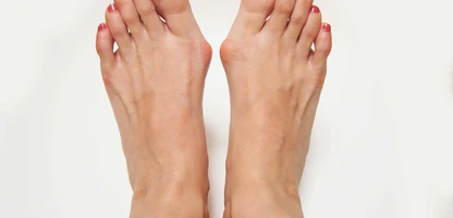 Hallux valgus aneb vbočený palec